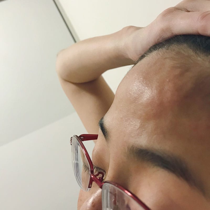 Swollen forehead from Lupus headaches